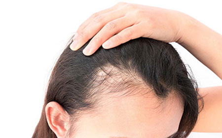 Demodex Hair Loss - Ungex Solutions Demodex Hair Loss - Ungex Solutions