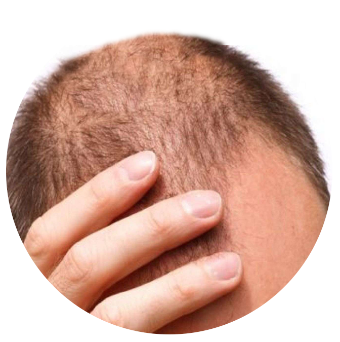 Demodex Hair Loss - Ungex Solutions Demodex Hair Loss - Ungex Solutions