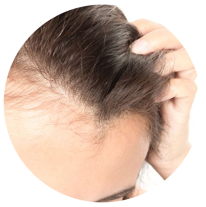Demodex Hair Loss - Ungex Solutions