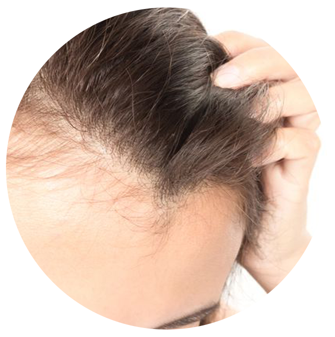 Demodex Hair Loss - Ungex Solutions Demodex Hair Loss - Ungex Solutions