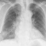 What are possible complications of COVID-19?