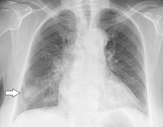 complications of COVID-19