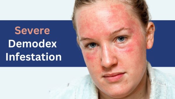 Identifying and Overcoming Severe Demodex Infestation - Ungex Solutions